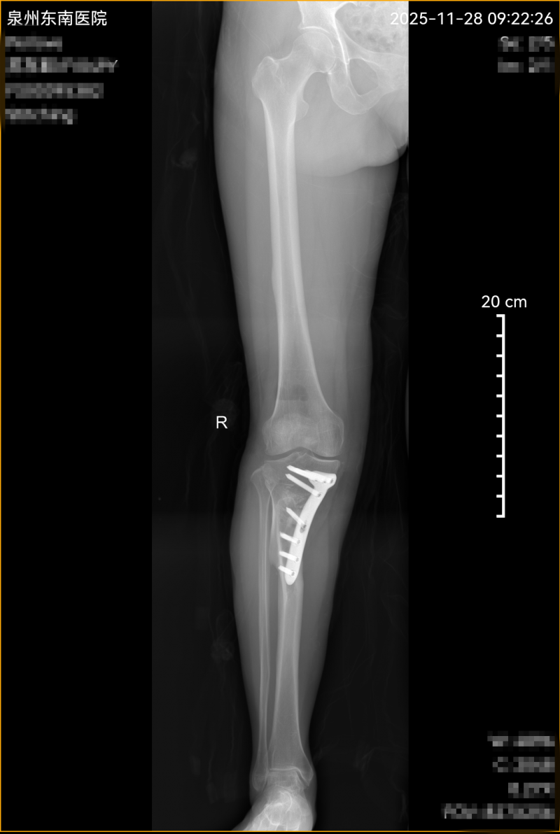 走路跛行腰也痛！49岁女子膝盖“歪”了22年，终于被“调直”